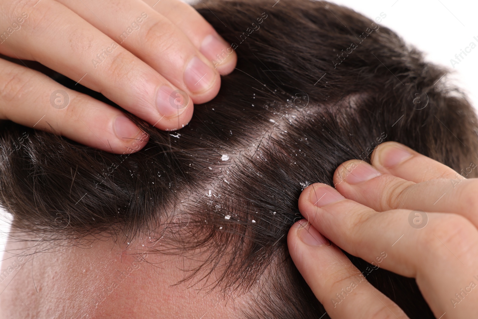 Photo of Man with dandruff in his dark hair, closeup