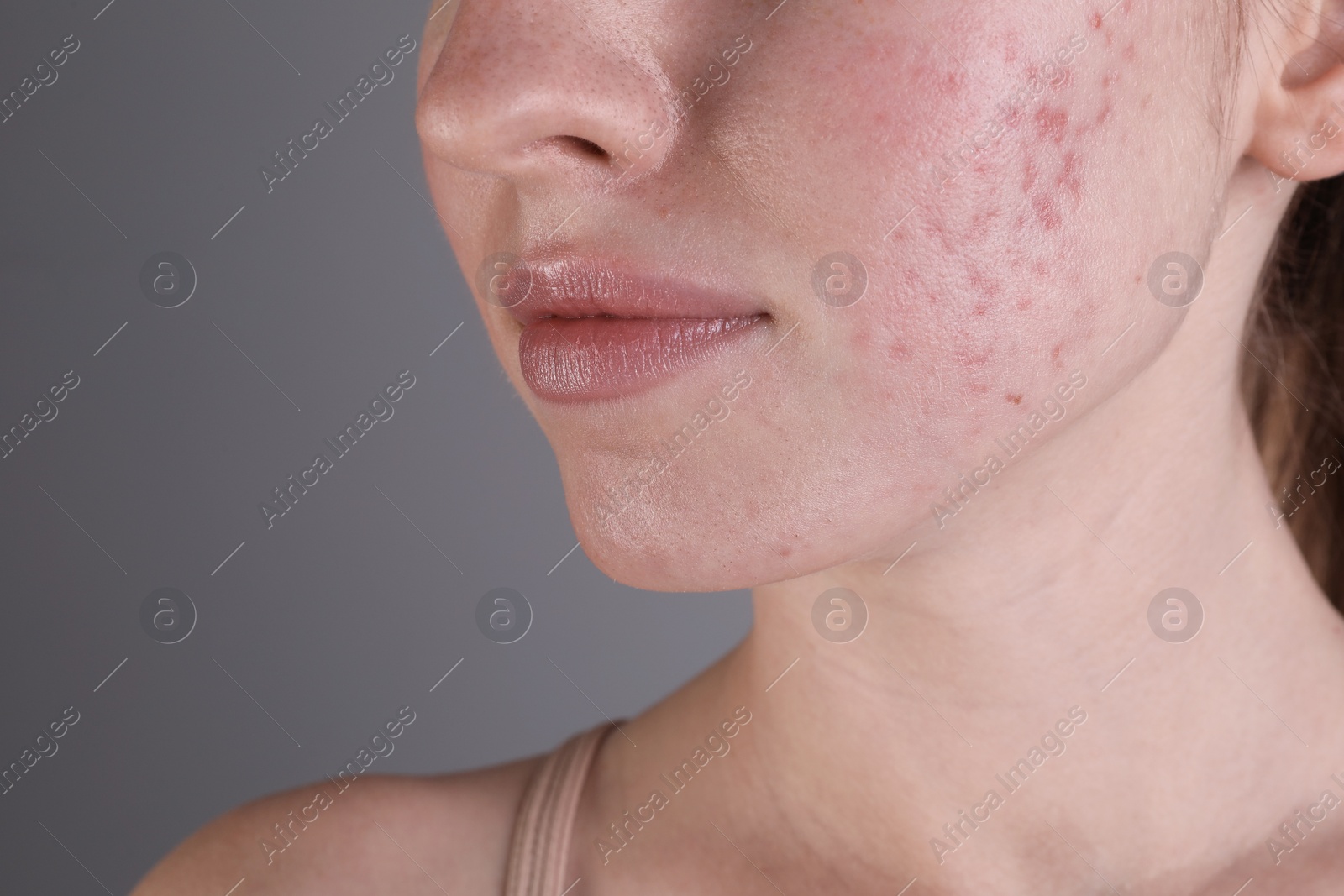 Photo of Young woman with acne problem on light grey background, closeup