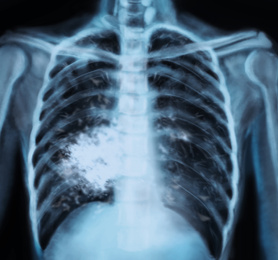 Illustration of  X-ray of patient with lung cancer. Illustration