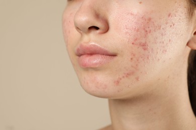 Photo of Teenage girl with acne problem on beige background, closeup