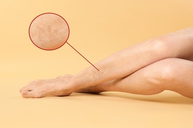 Image of Woman suffering from varicose veins on pastel gold background, closeup. Magnified skin surface showing affected area