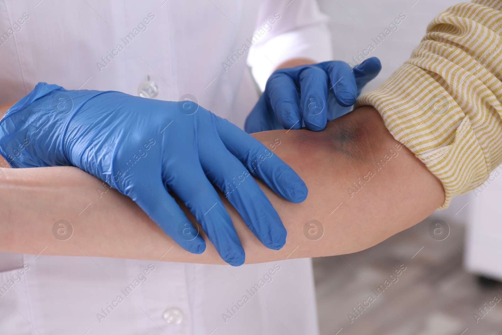 Photo of Doctor checking woman's elbow with bruise at hospital, closeup