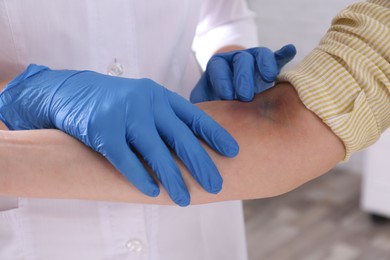 Photo of Doctor checking woman's elbow with bruise at hospital, closeup