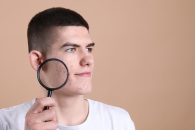 Photo of Young man with acne problem holding magnifying glass on beige background. Space for text