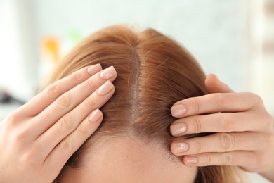 Photo of Young woman with hair loss problem, closeup