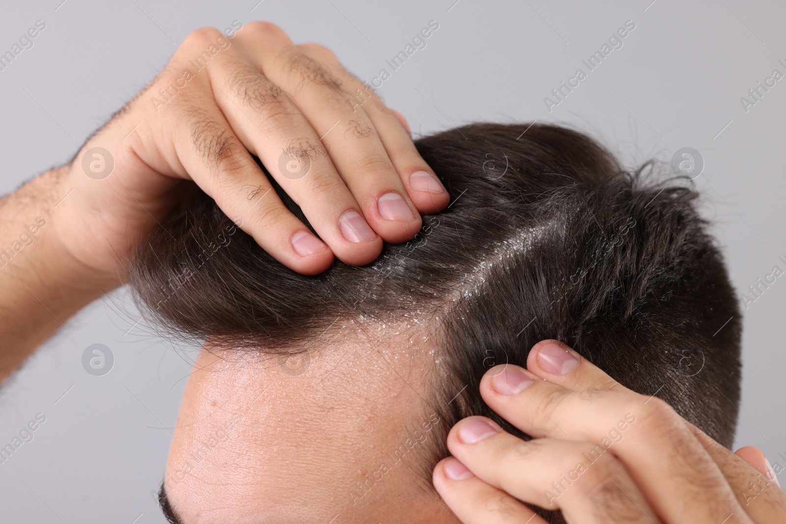 Photo of Man with dandruff in his dark hair on light grey background, closeup