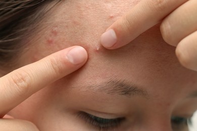 Photo of Young woman touching pimple on her face, closeup. Acne problem
