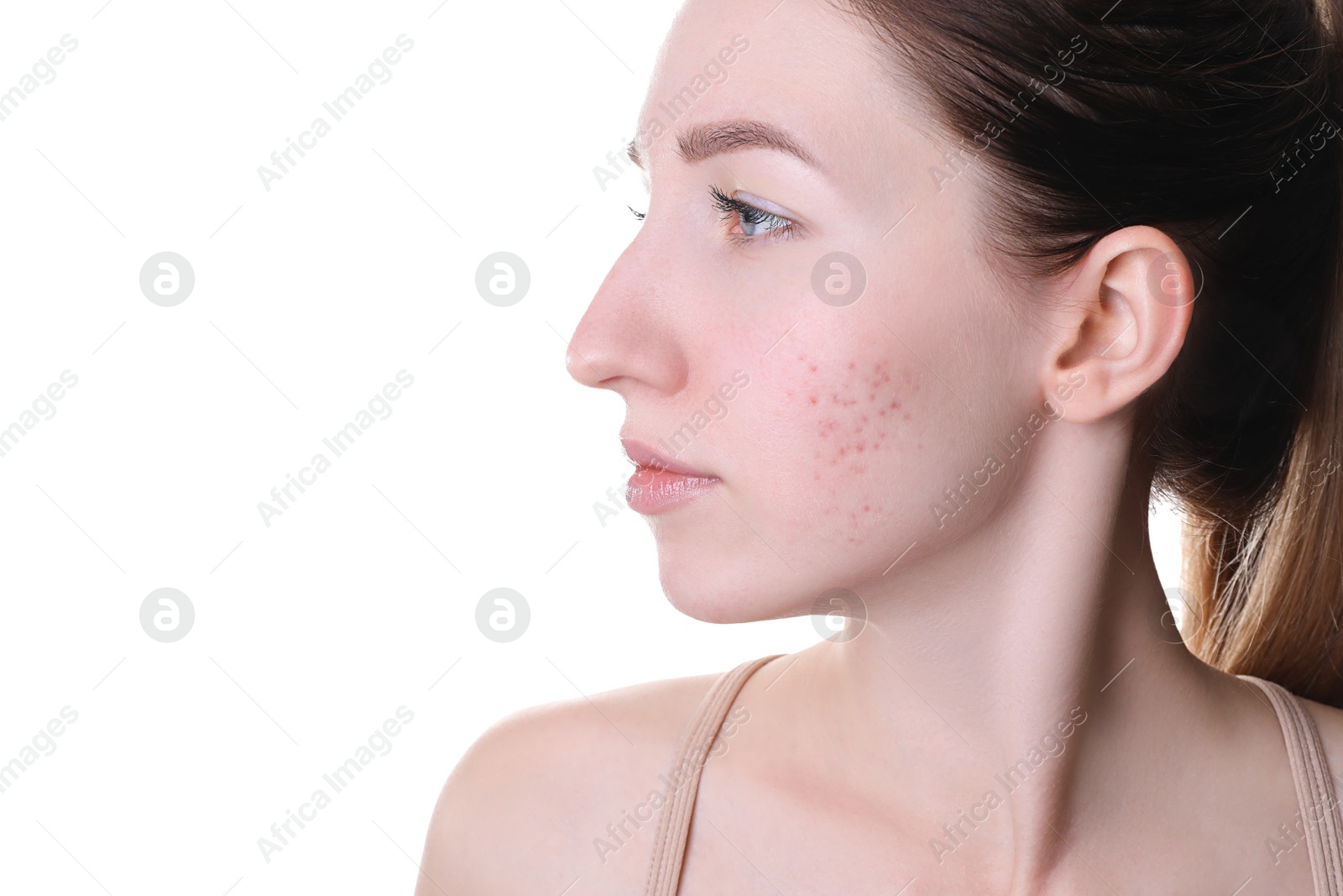 Photo of Young woman with acne problem on white background