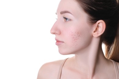 Young woman with acne problem on white background