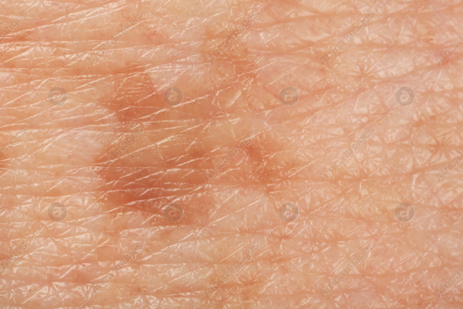 Photo of Texture of skin with pigmentation as background, macro view