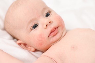 Photo of Cute little baby with allergic redness on cheeks lying on white blanket, closeup