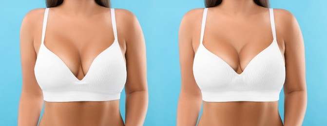 Image of Collage with photos of woman before and after breast-lift surgery on light blue background, closeup