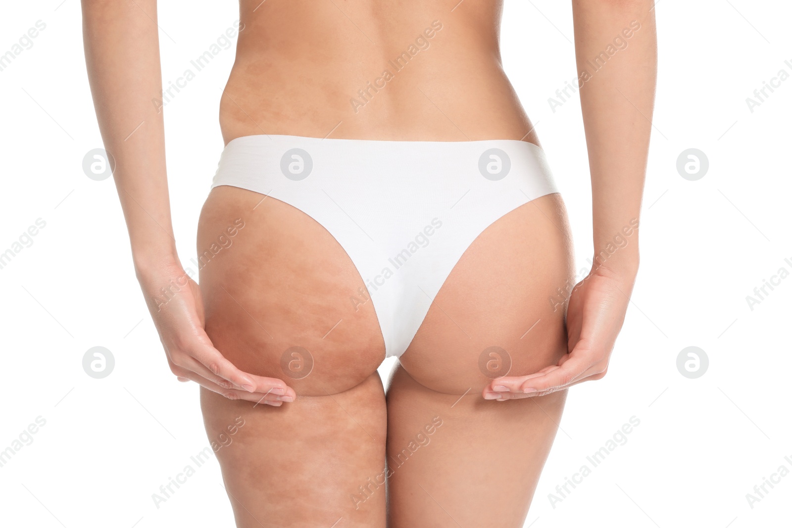 Image of Young woman in underwear before and after beauty procedure on white background, closeup. Body care