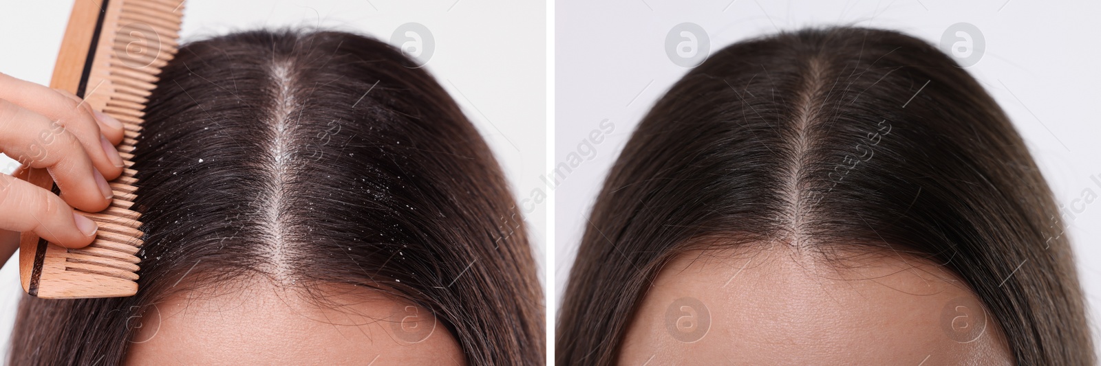 Image of Woman showing hair before and after dandruff treatment on light background, collage