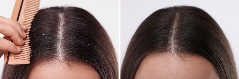 Woman showing hair before and after dandruff treatment on light background, collage