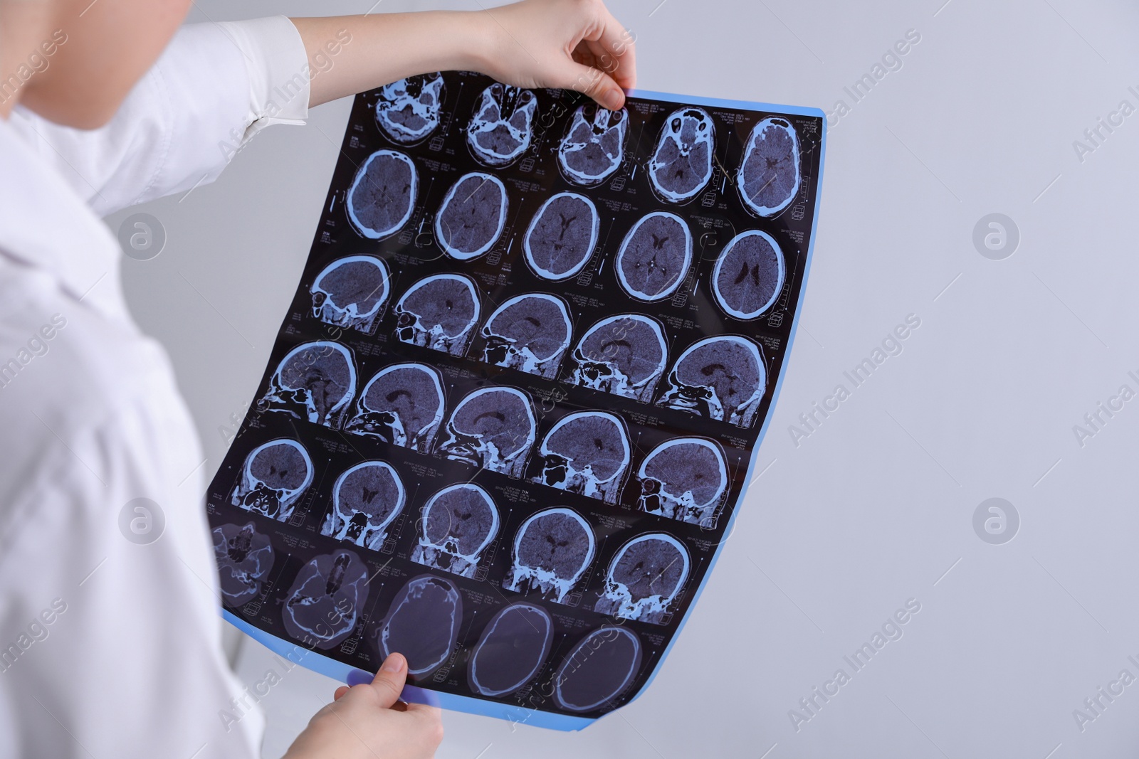 Photo of Doctor examining MRI images of patient with multiple sclerosis in clinic, closeup