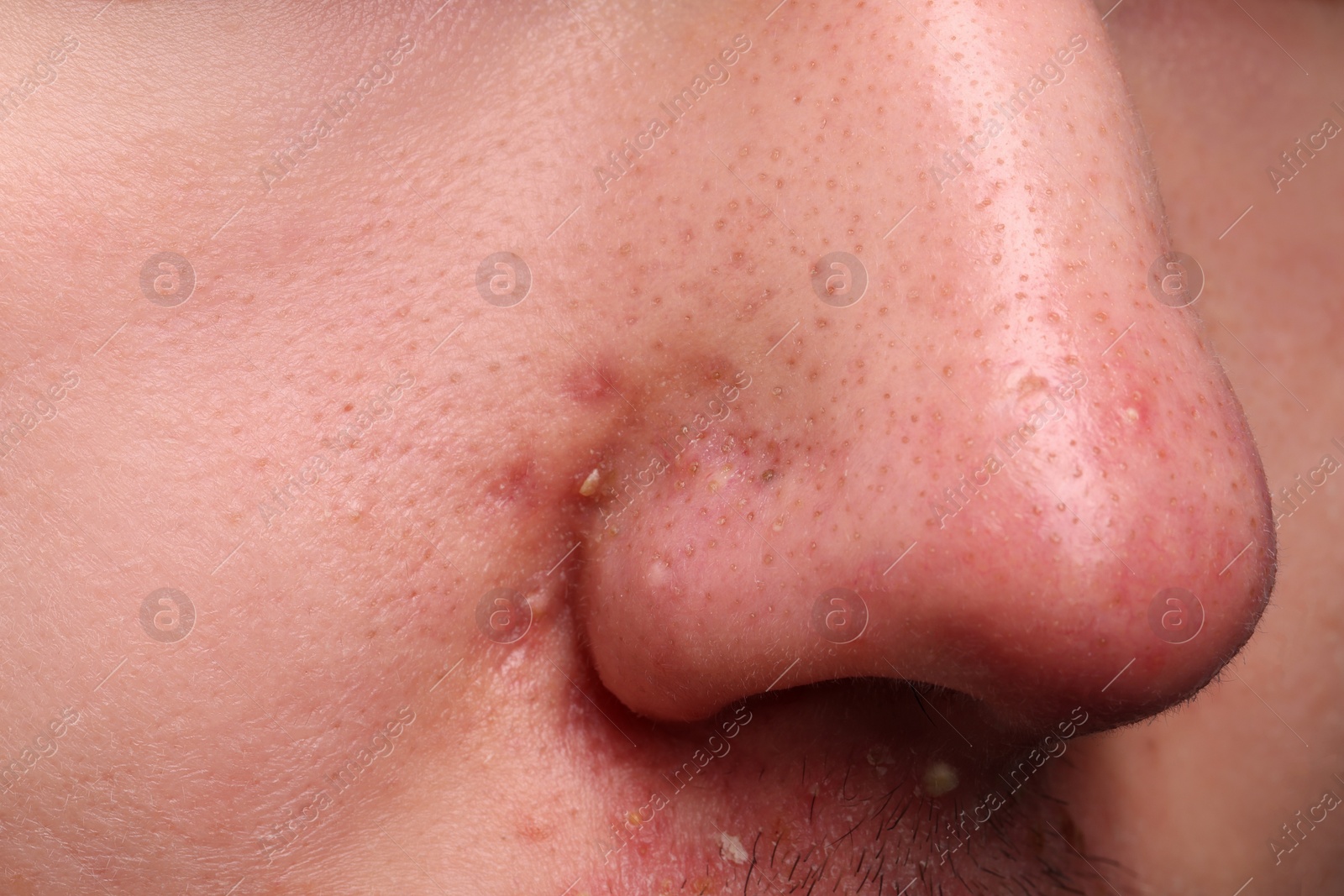 Photo of Young man with acne problem, closeup view of nose