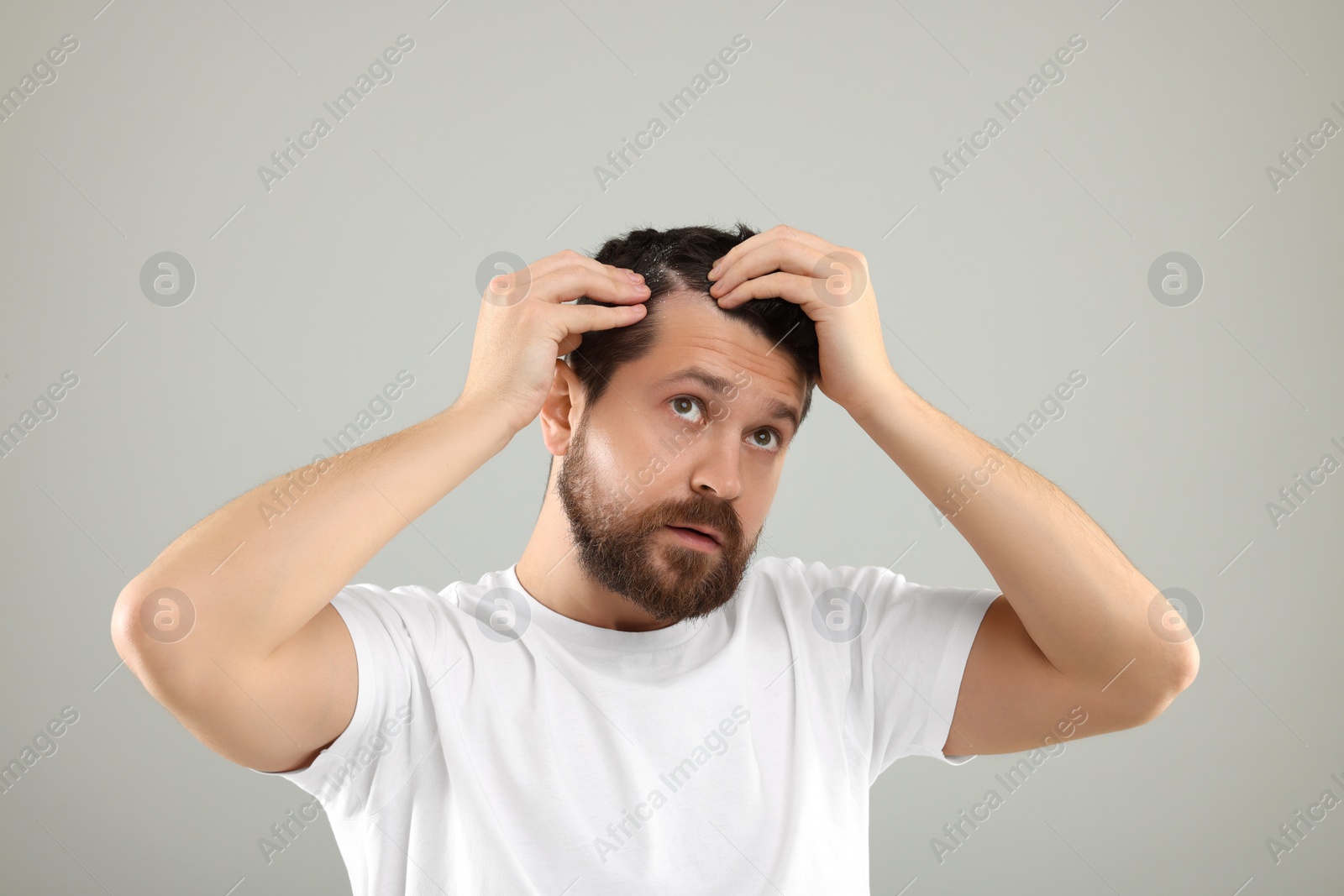 Photo of Man with dandruff in his dark hair on light gray background
