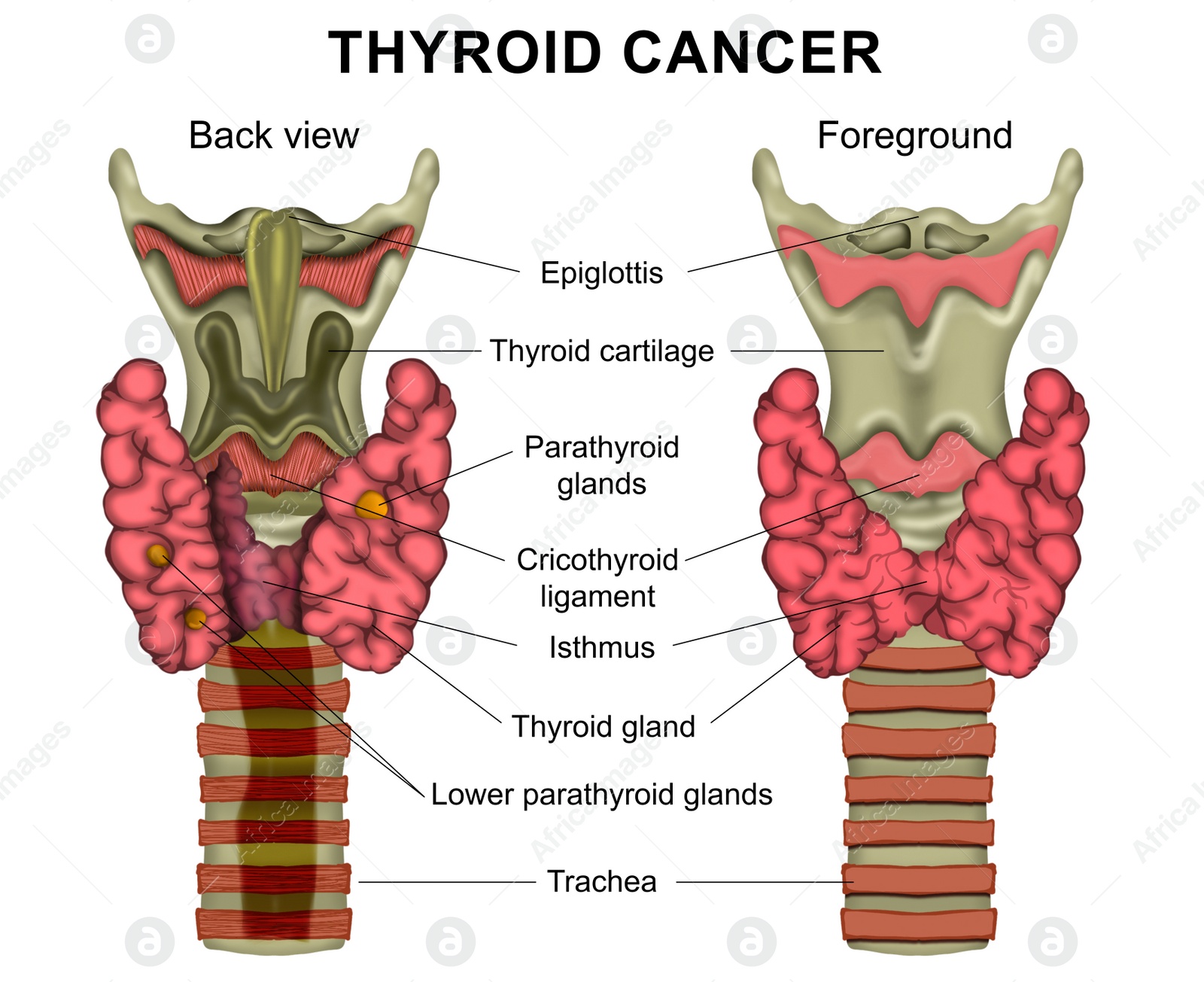 Illustration of  human thyroid cancer on white background. Back view and foreground