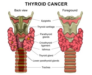 Illustration of Illustration of human thyroid cancer on white background. Back view and foreground