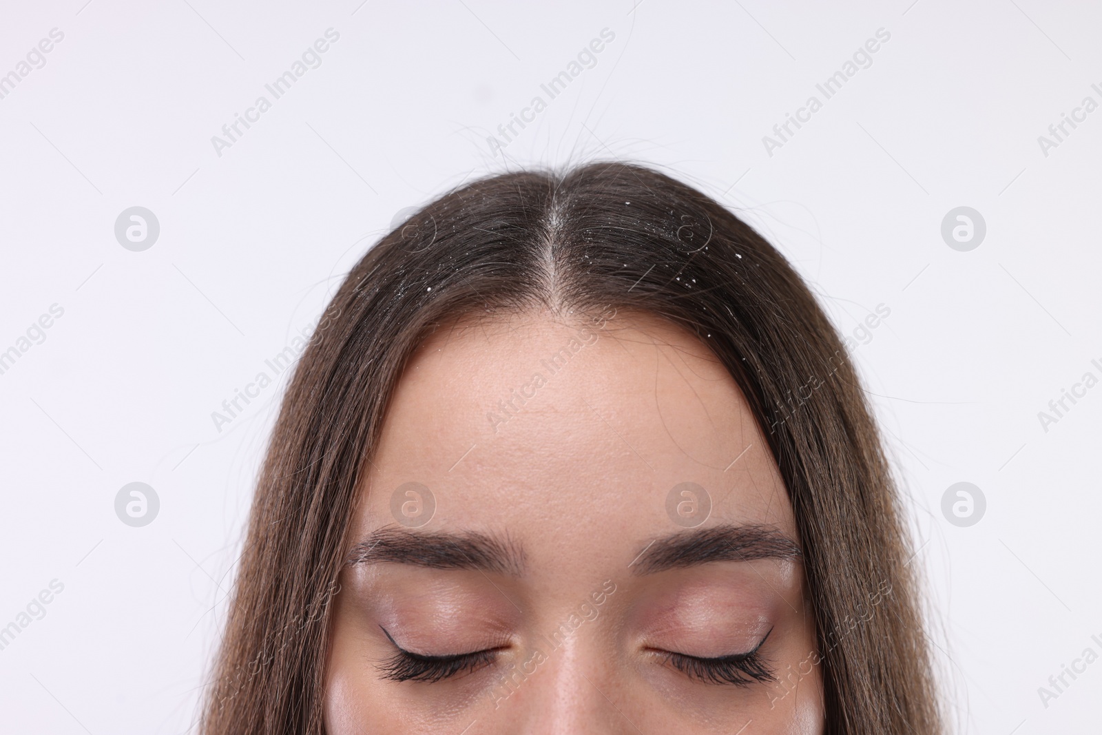 Photo of Woman with dandruff problem on white background, closeup