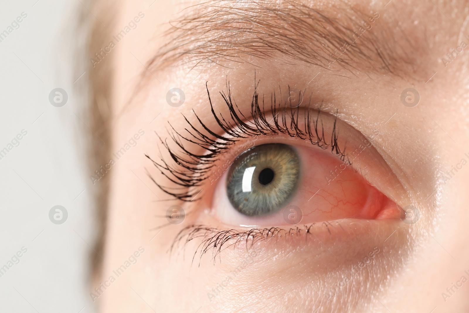 Image of Woman with red eye suffering from conjunctivitis on light background, closeup