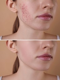 Image of Acne problem. Young woman before and after treatment on beige background, closeup. Collage of photos