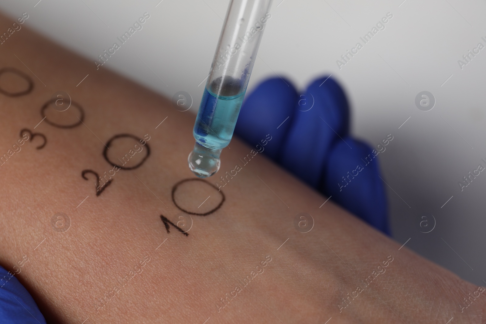 Photo of Patient undergoing skin allergy test at light table in clinic, closeup