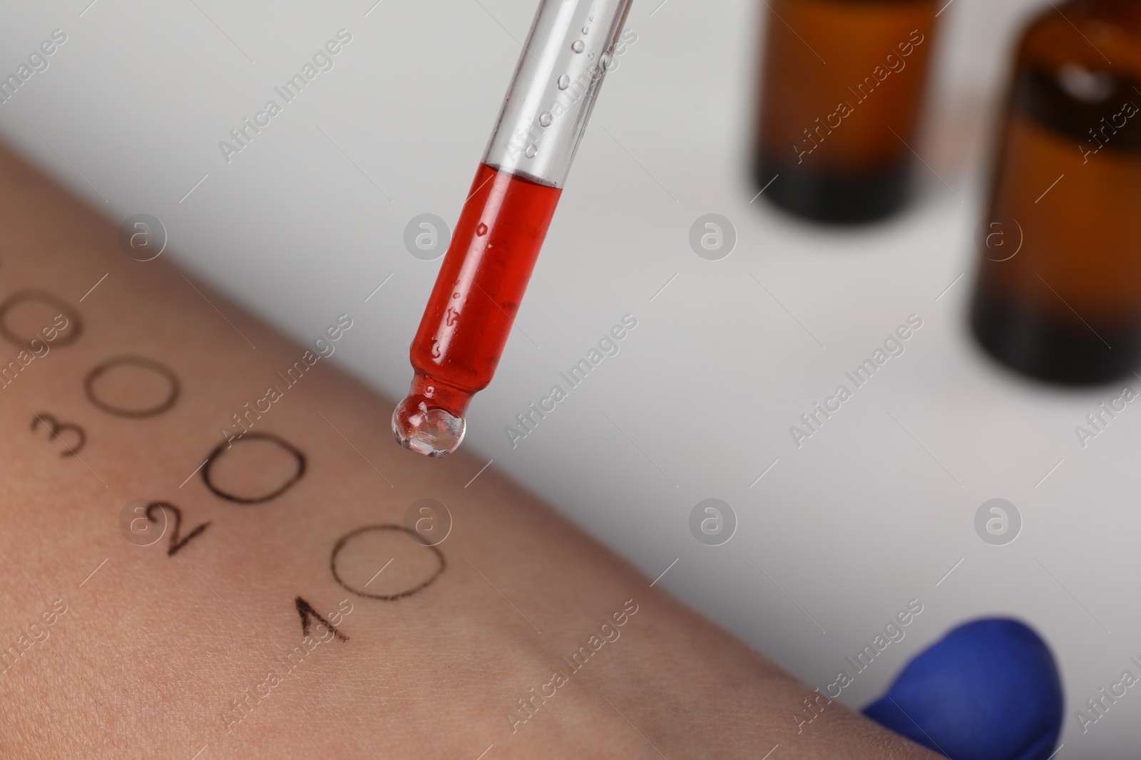 Photo of Patient undergoing skin allergy test at light table in clinic, closeup