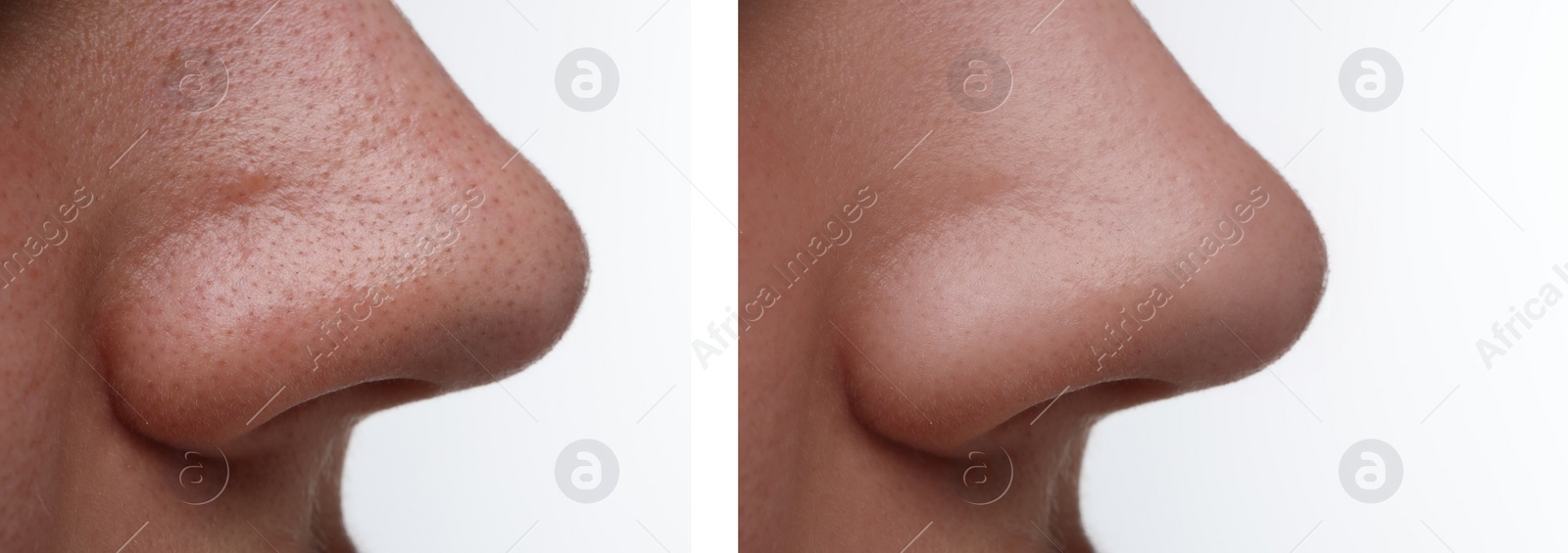 Image of Before and after acne treatment. Photos of woman on white background, closeup. Collage showing affected and healthy skin