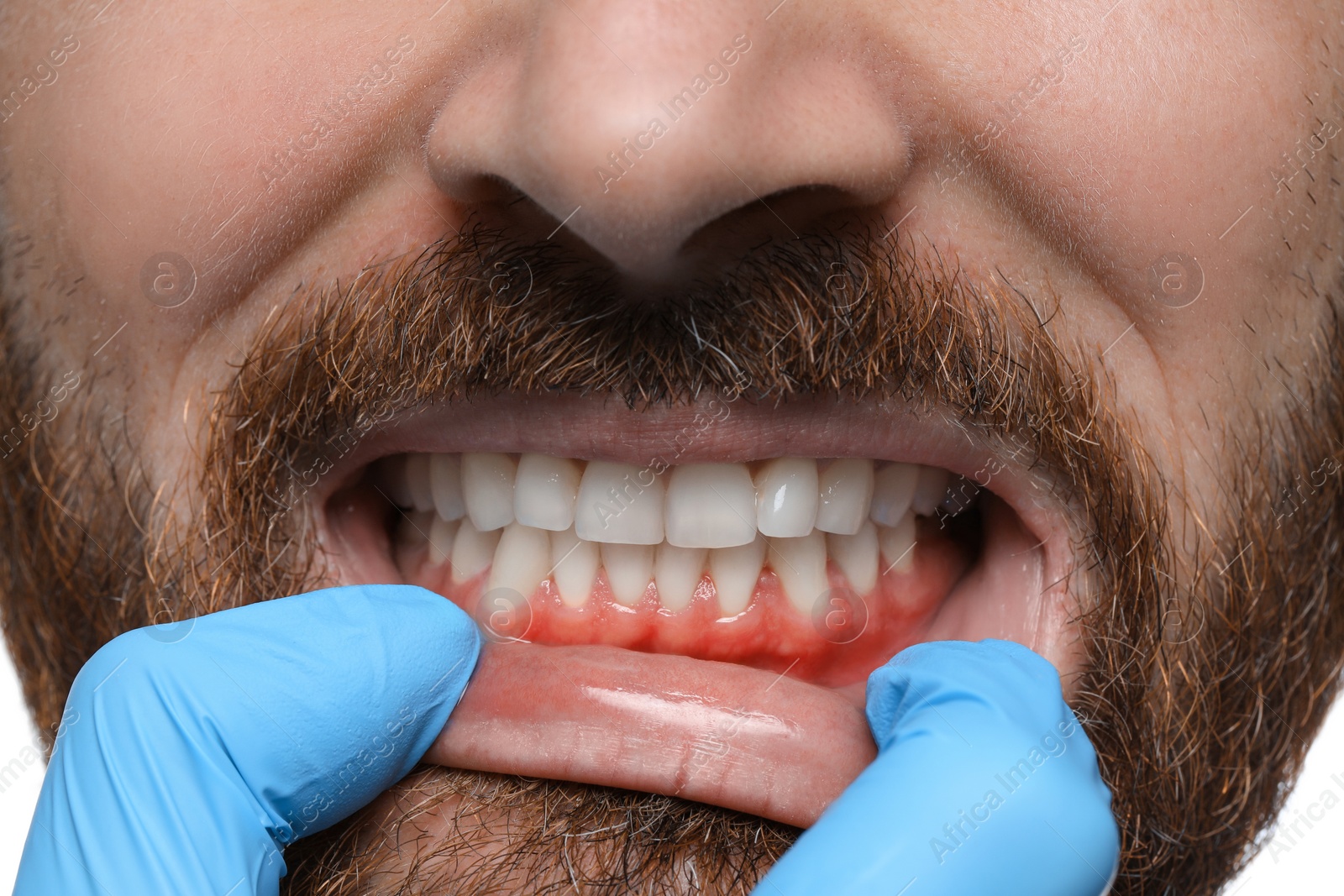 Image of Doctor examining man's inflamed gum, closeup. Oral cavity health