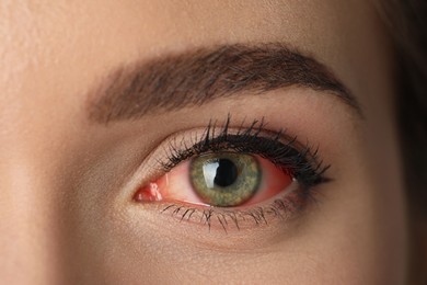 Image of Woman suffering from conjunctivitis, closeup of red eye