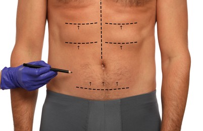 Image of Man preparing for cosmetic surgery, white background. Doctor drawing markings on his abdomen, closeup