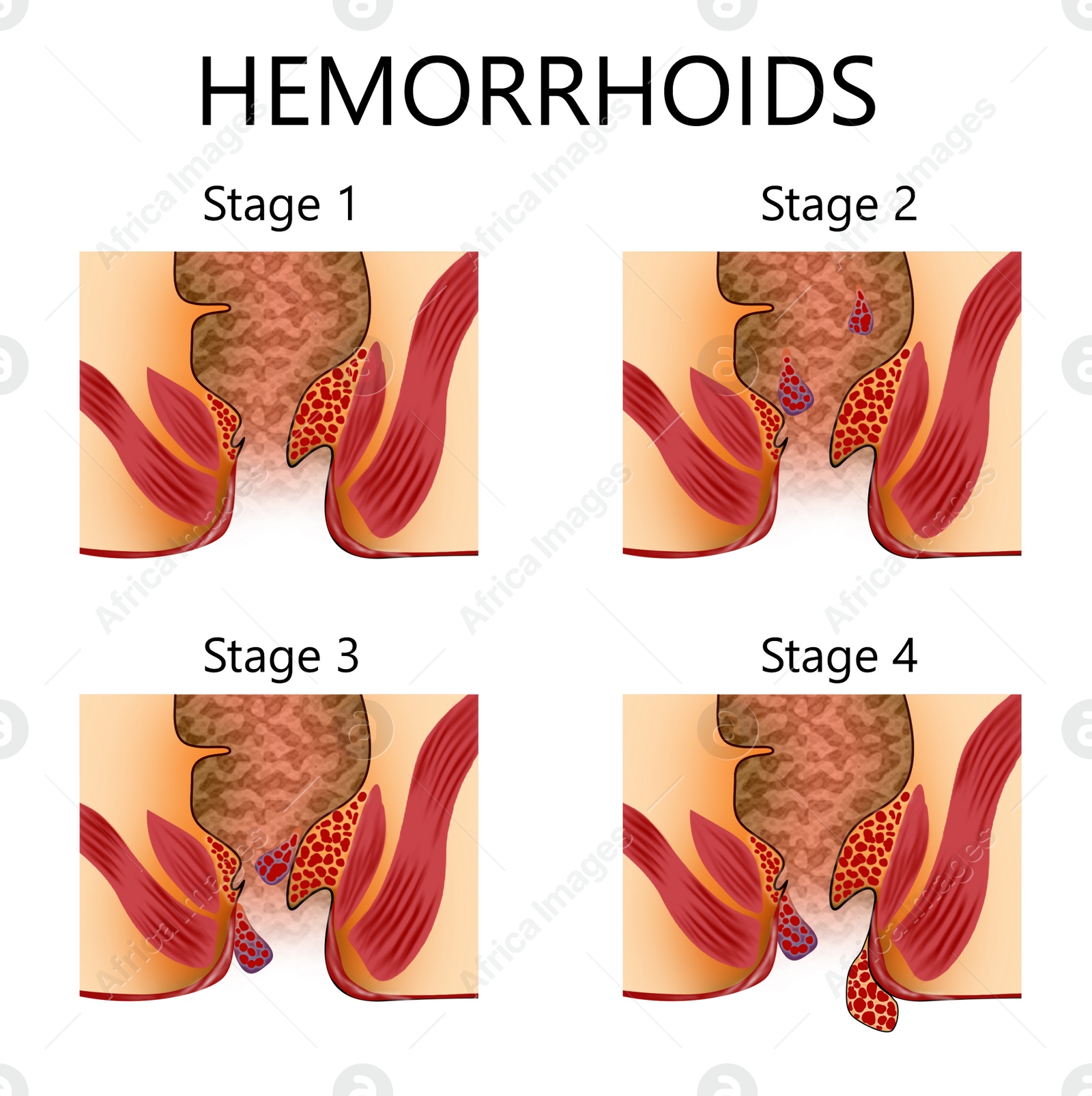 Image of Hemorrhoid stages. Unhealthy lower rectum with inflamed vascular structures, illustration