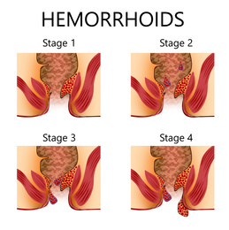 Hemorrhoid stages. Unhealthy lower rectum with inflamed vascular structures, illustration