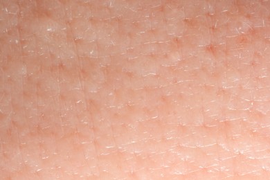 Photo of Texture of dry skin as background, macro view