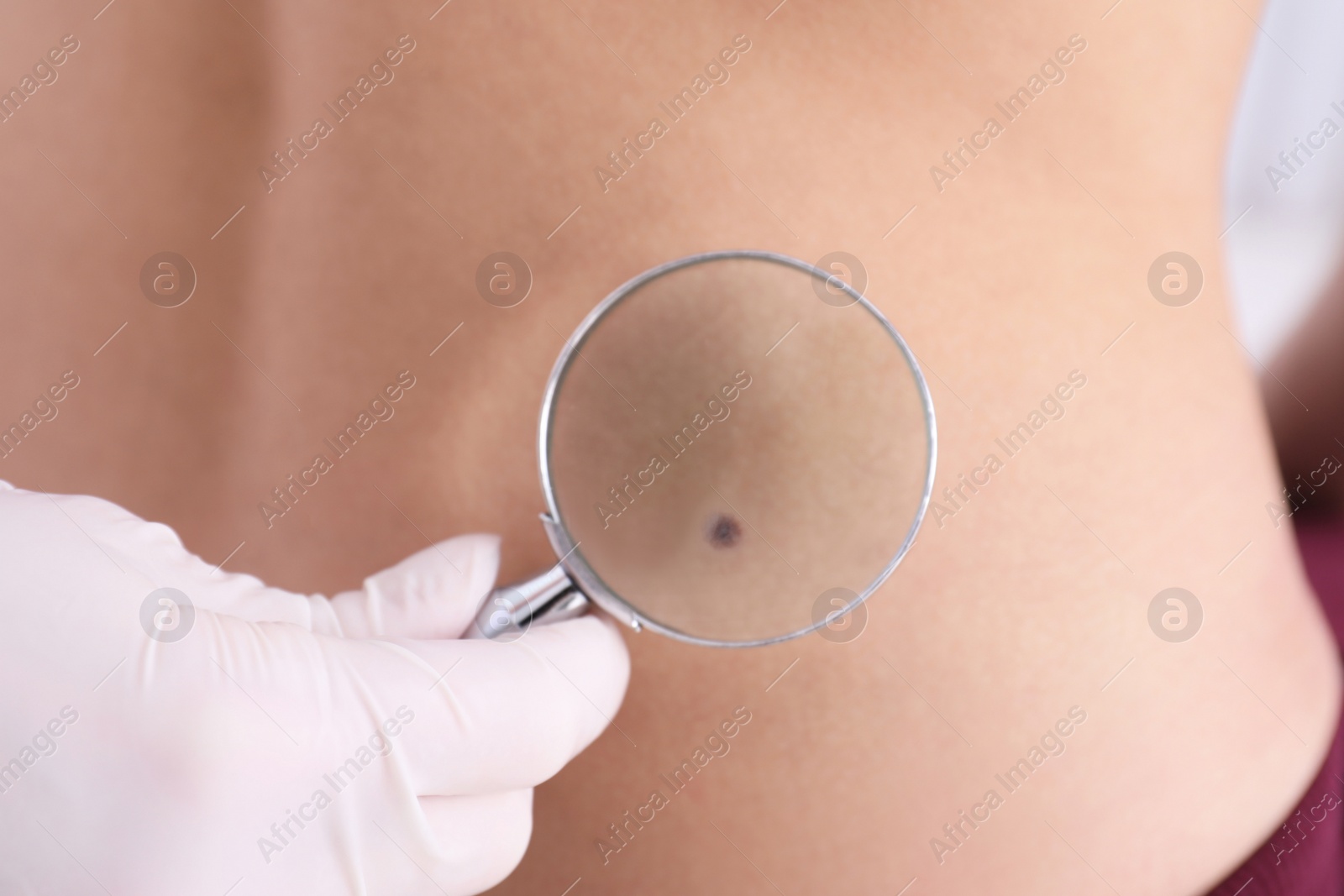 Photo of Dermatologist examining patient with magnifying glass in clinic, closeup view
