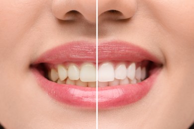 Image of Woman showing teeth before and after whitening, collage