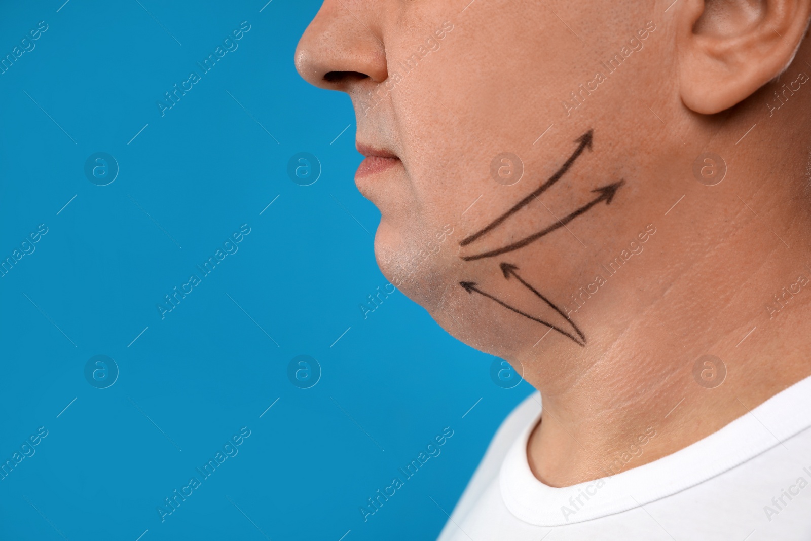 Photo of Mature man with marks on face against blue background, closeup. Double chin removal