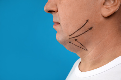 Photo of Mature man with marks on face against blue background, closeup. Double chin removal