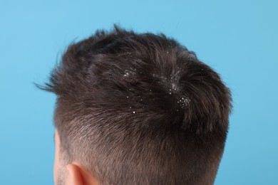 Photo of Man with dandruff in his dark hair on light blue background, closeup