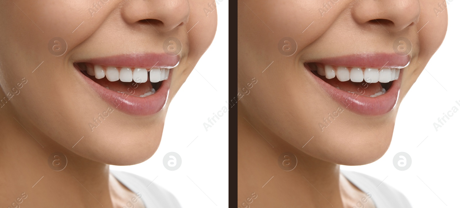 Image of Collage with photos of woman with diastema between upper front teeth before and after treatment on white background, closeup. Banner design