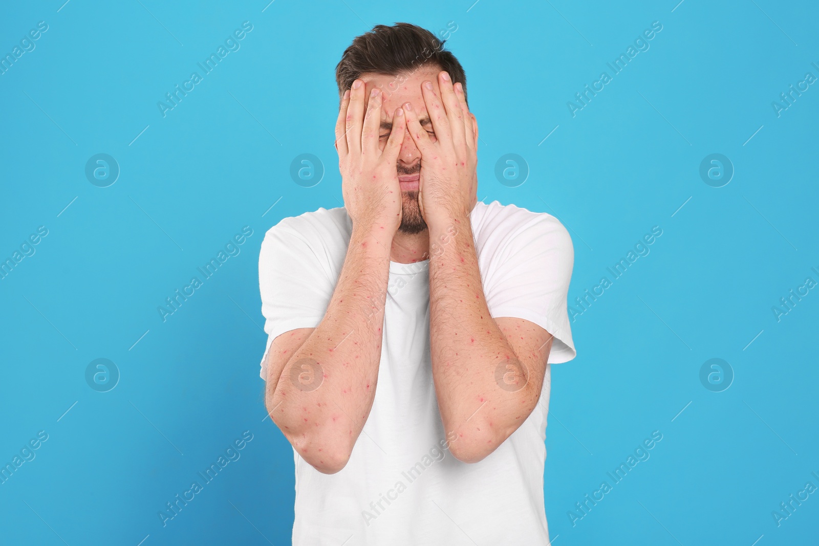 Photo of Man with rash suffering from monkeypox virus on light blue background. Space for text