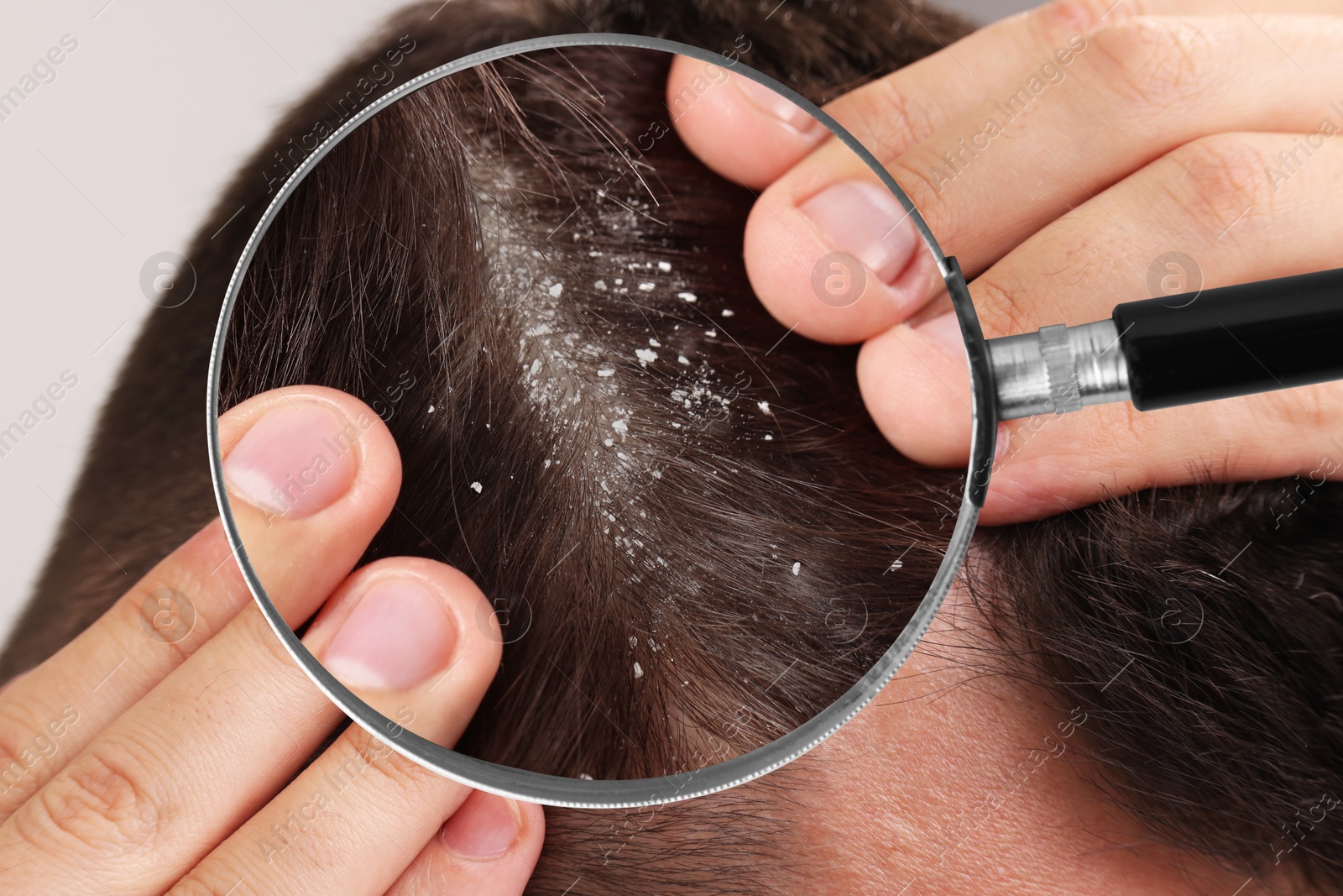Image of Man suffering from dandruff on light background, closeup. View through magnifying glass on hair with flakes