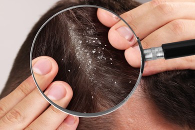 Man suffering from dandruff on light background, closeup. View through magnifying glass on hair with flakes