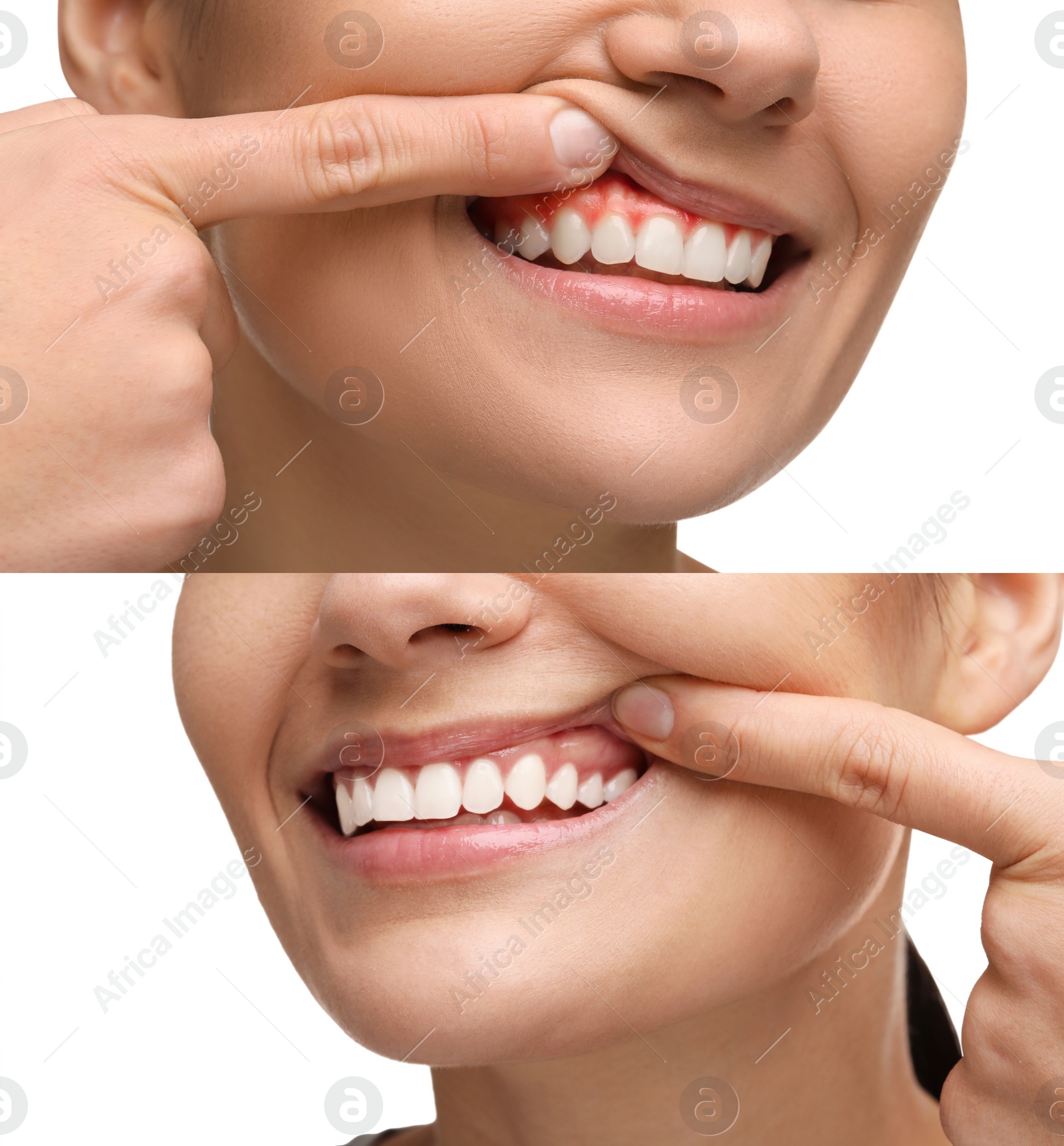 Image of Woman showing gum before and after treatment on white background, collage of photos