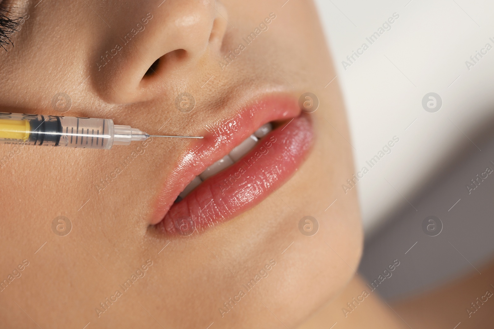 Photo of Young woman getting lips injection, closeup. Cosmetic surgery