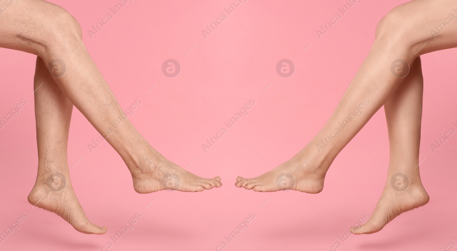 Image of Before and after varicose veins treatment. Collage with photos of woman showing legs on pink background, closeup