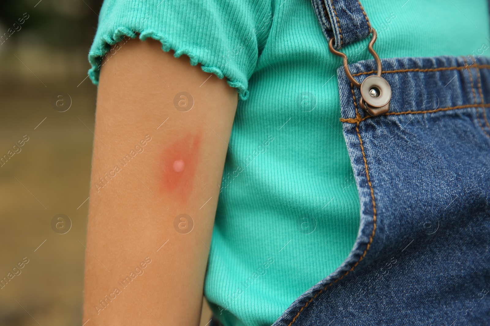 Photo of Girl with insect bite on arm outdoors, closeup