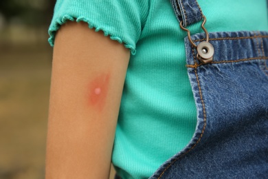 Photo of Girl with insect bite on arm outdoors, closeup
